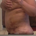 This is the right side of incision nice and flat