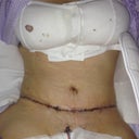 Tummy, po day 2 My hips/thighs look huge with the way I am sitting! I swear they aren't that big!
