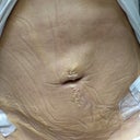 Lumpy stomach when garment comes off
