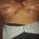 Brusing under the breast day 6