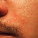 bumps and line(fine lines and sometimes not visible when not smiling alot or sleeping on them)
