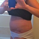 PO Day 12 - Swollen and fat - Look at that gut!!!  Where is my flat tummy I was supposed to have?  :-(