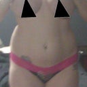 Before Surgery- Notice how the stomache pokes out and the flanks come out wider than the hips.