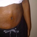 12 days post op- I've got a lot of stretchmarks, but that's fine because it doesn't look like the above photo.