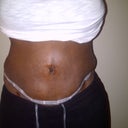 12 days post op- bizarre swelling and knots at the areas that were liposuctinoed.