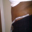 12 days post op