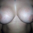 A little over 2 years, after Breast Augmentation.