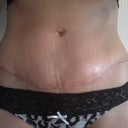 11 week picture, scar is fading. Wish i could get rid of stretch marks!