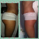 B4 pic & 1 month post op