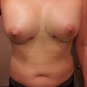 2 days post op - 510 cc each breast.