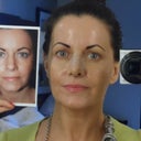 Photo taken 5 days post surgery and the day my cast came off. Nose is still taped and the black bit under my nose is the stitches, which came out 2 days after my cast (with no scar - amazing!)  Shown with 'before' pic of my nose which was taken the day before surgery by Dr Rizk.