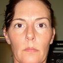 This is my before crooked face