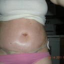 Day 6 post op!