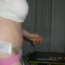 Day 6 post op side view