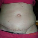 Day 19 post op.  Swollen!