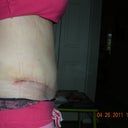 Day 19 post op side view...