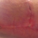 Underside of my left breast where the incision opened up. Doc says it's probably a stitch working it's way out. Post op one month