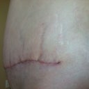 No real change in swelling from week three. Post op one month