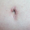 One month post op