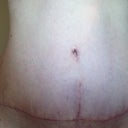 Post op one month. Not much change from last week.