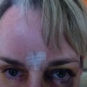 Right eye bruised more...that's normal.