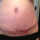 There's a bit of bulging above the incision, but it's where I still have stretch marks. Plus I'm swollen a bit. So we'll wait n see!