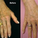 This is very similar to the results I got.  NOT my hands.  I'm not married.  The change was very welcome and lasted  a year without the cream.
