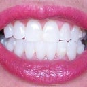 After wearing them now 1-1/2 yrs.  In person the front teeth still slightly sit over the sides.  On a recent visit I asked to have the bell shape shaved on each side hoping that will help them move.