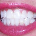 I really did not want to still be wearing them 1-1/2 yrs, but I am. The right bottom teeth are misaligned.
