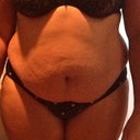 Pre Op Front