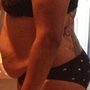 Pre Op Side View