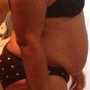 Pre Op Side View
