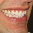 Before Starting Invisalign