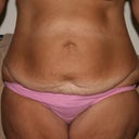 This was before surgery