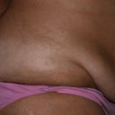 This was before surgery