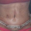 This is 8 days after surgery