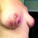1 day post op