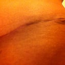 6 Weeks PO Left Drain