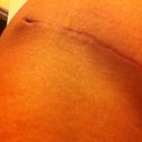 Right Drain hole that reopened is healing just like the left now