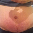 Scar at 3 wks 3 days , scab in the middle.