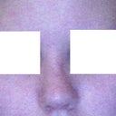 Bad quality Webcam picture after surgery from the front, it is actually even worse IRL. But it gives an idea of what I am talking about non the less.