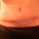 20 day PO... Tummy scar and bb. Healing very well. :)