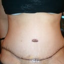 Front: 10 days post-op