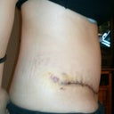 Side: 10 days post-op