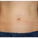 CoolSculpting
