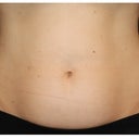 CoolSculpting