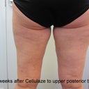 6 weeks after Cellulaze to upper posterior thighs