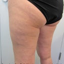 6 weeks after Cellulaze to upper posterior thighs