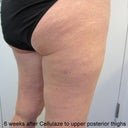 6 weeks after Cellulaze to upper posterior thighs