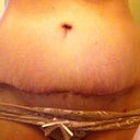 Scar at 3 weeks post op